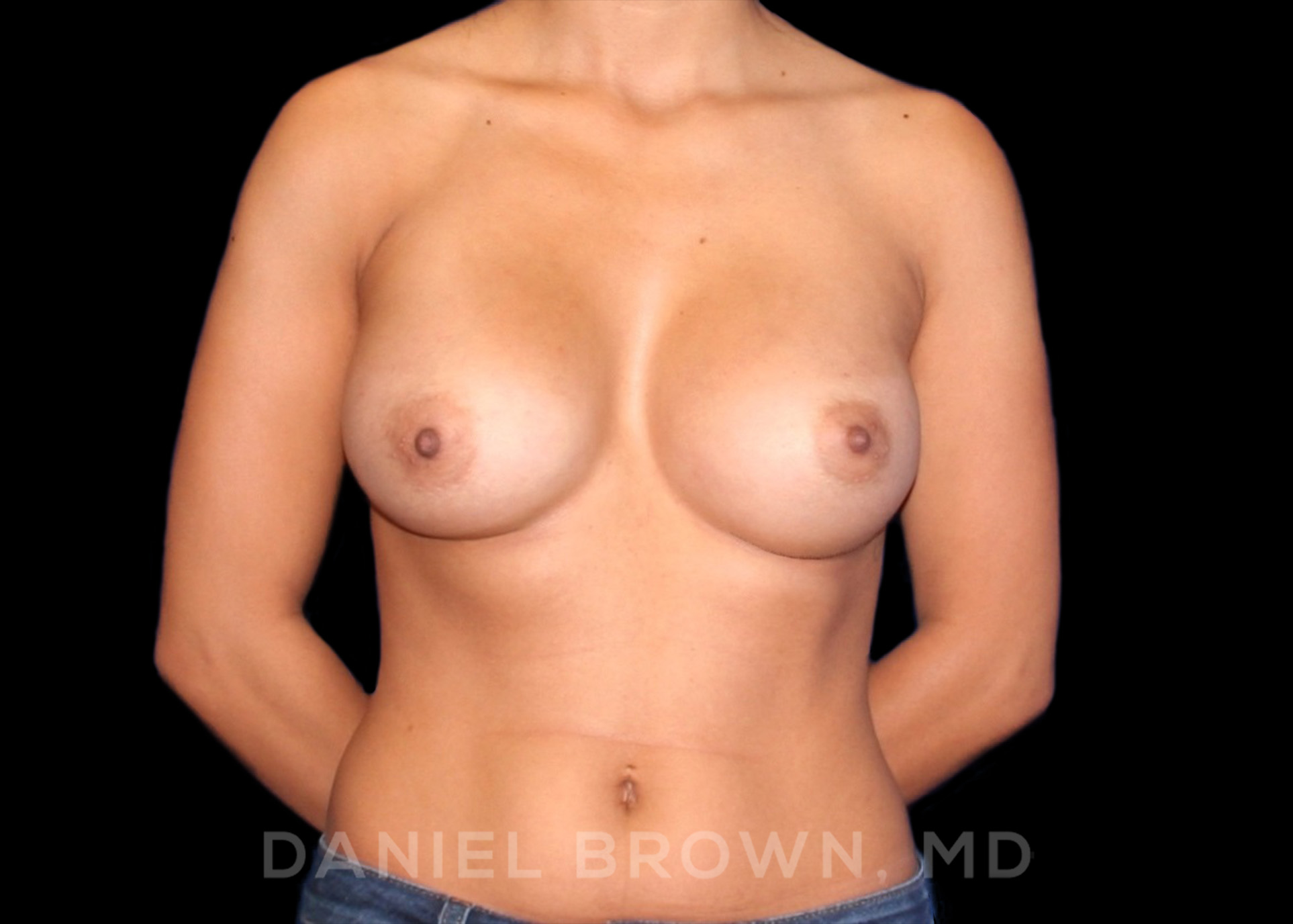 Breast Augmentation Patient Photo - Case 2242 - after view-0