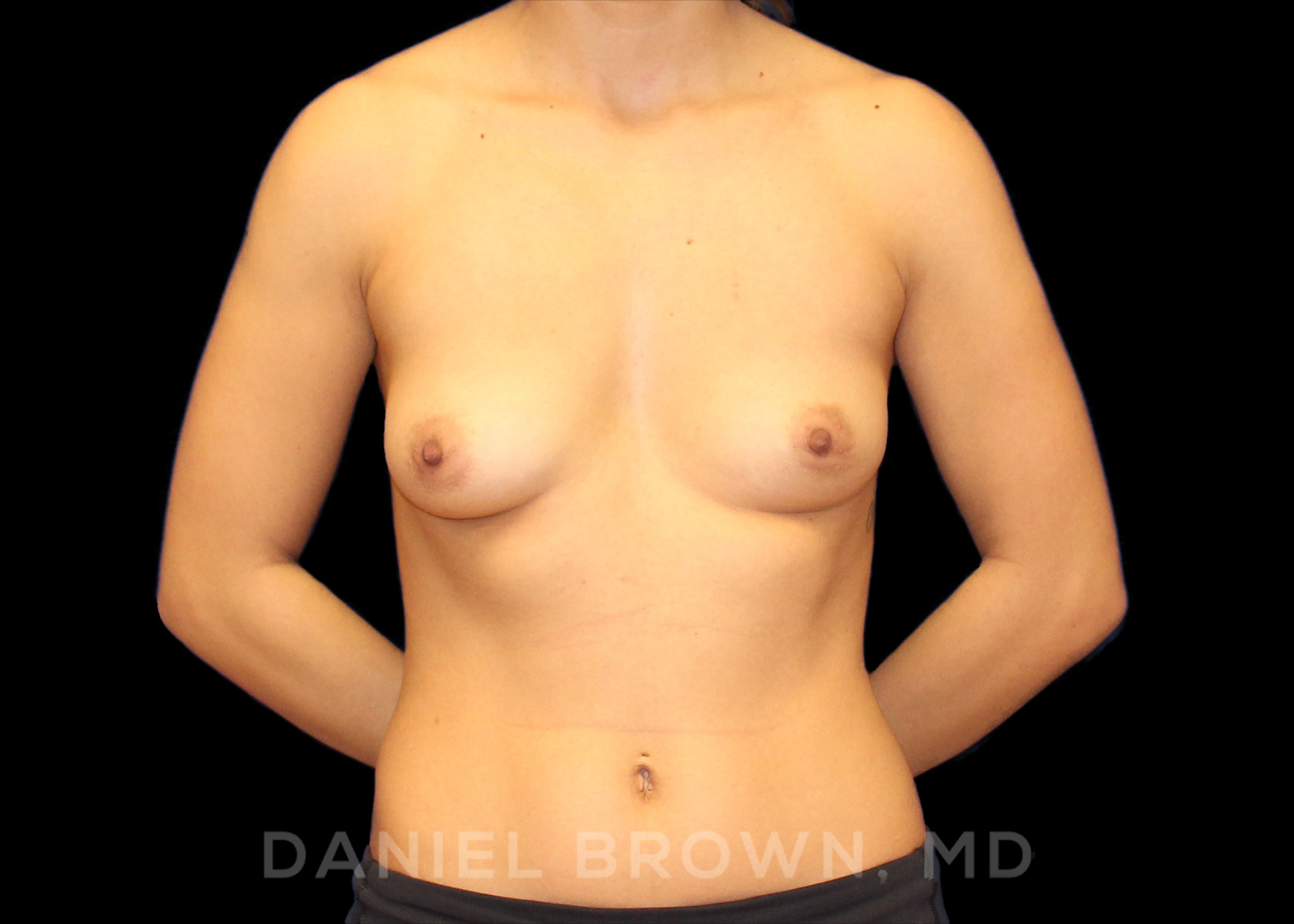Breast Augmentation Patient Photo - Case 2242 - before view-