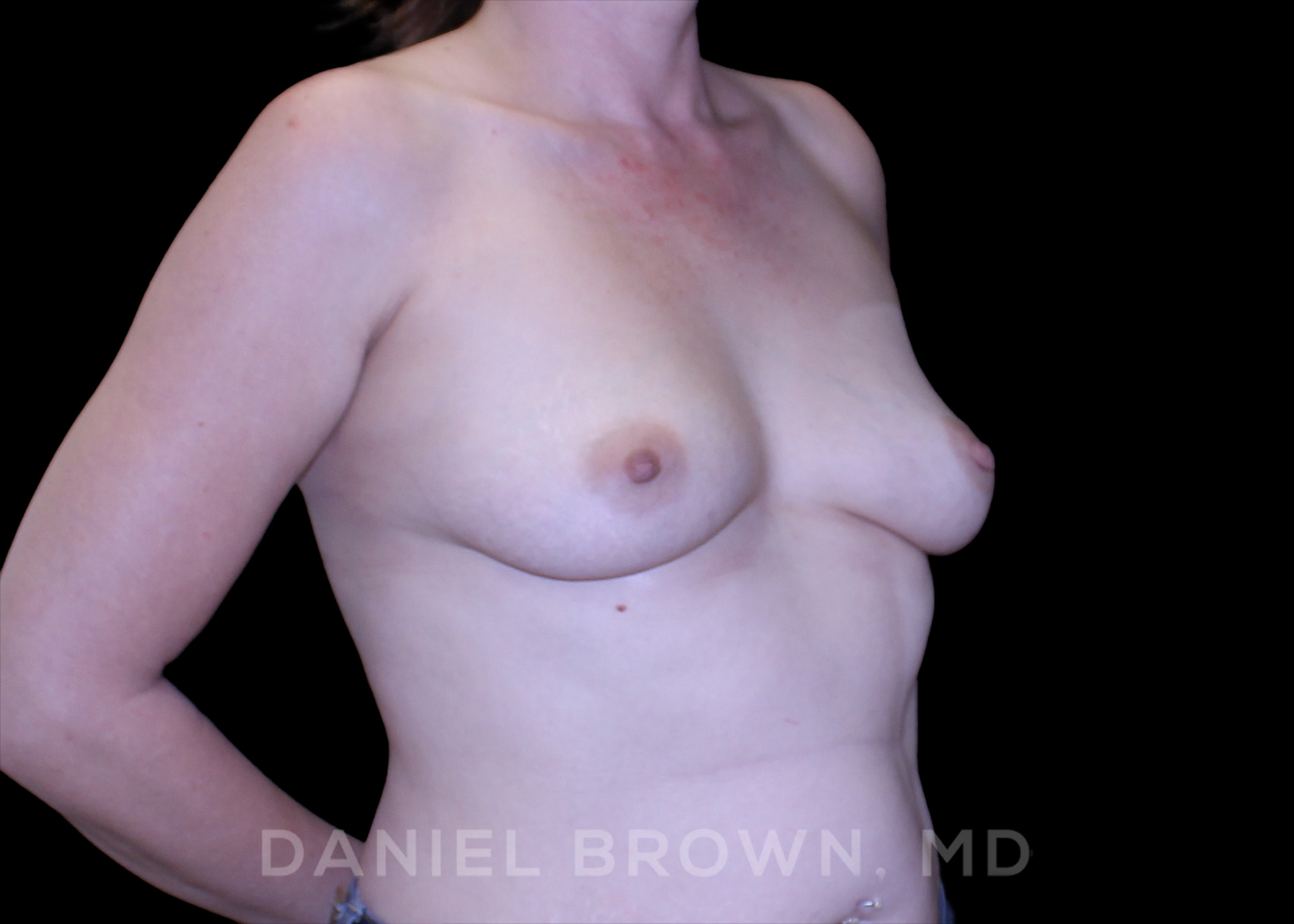Breast Augmentation Patient Photo - Case 2249 - before view-2