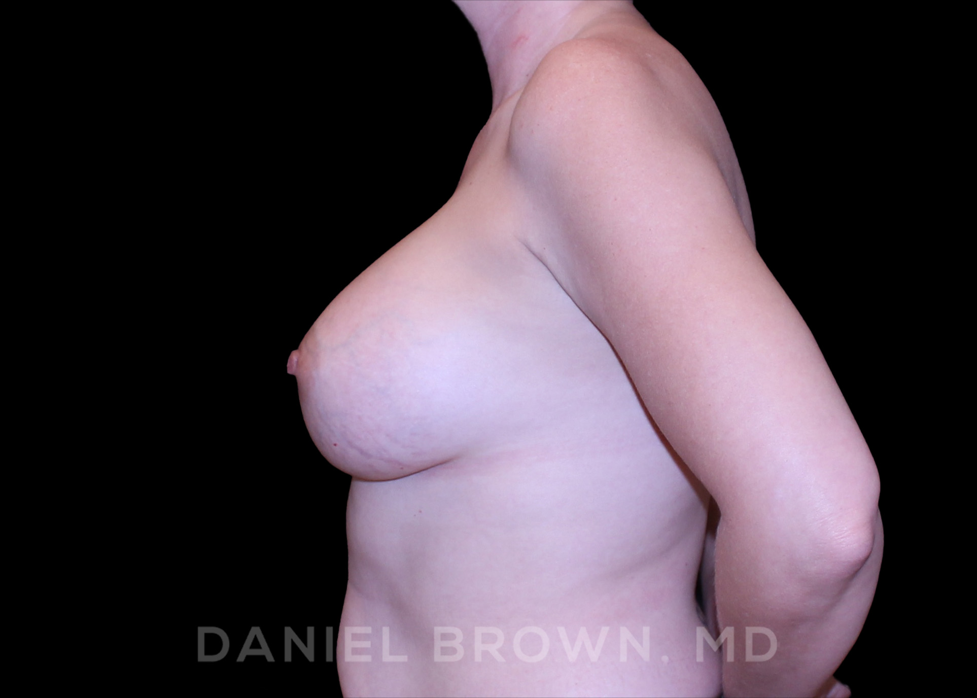 Breast Augmentation Patient Photo - Case 2249 - after view-3