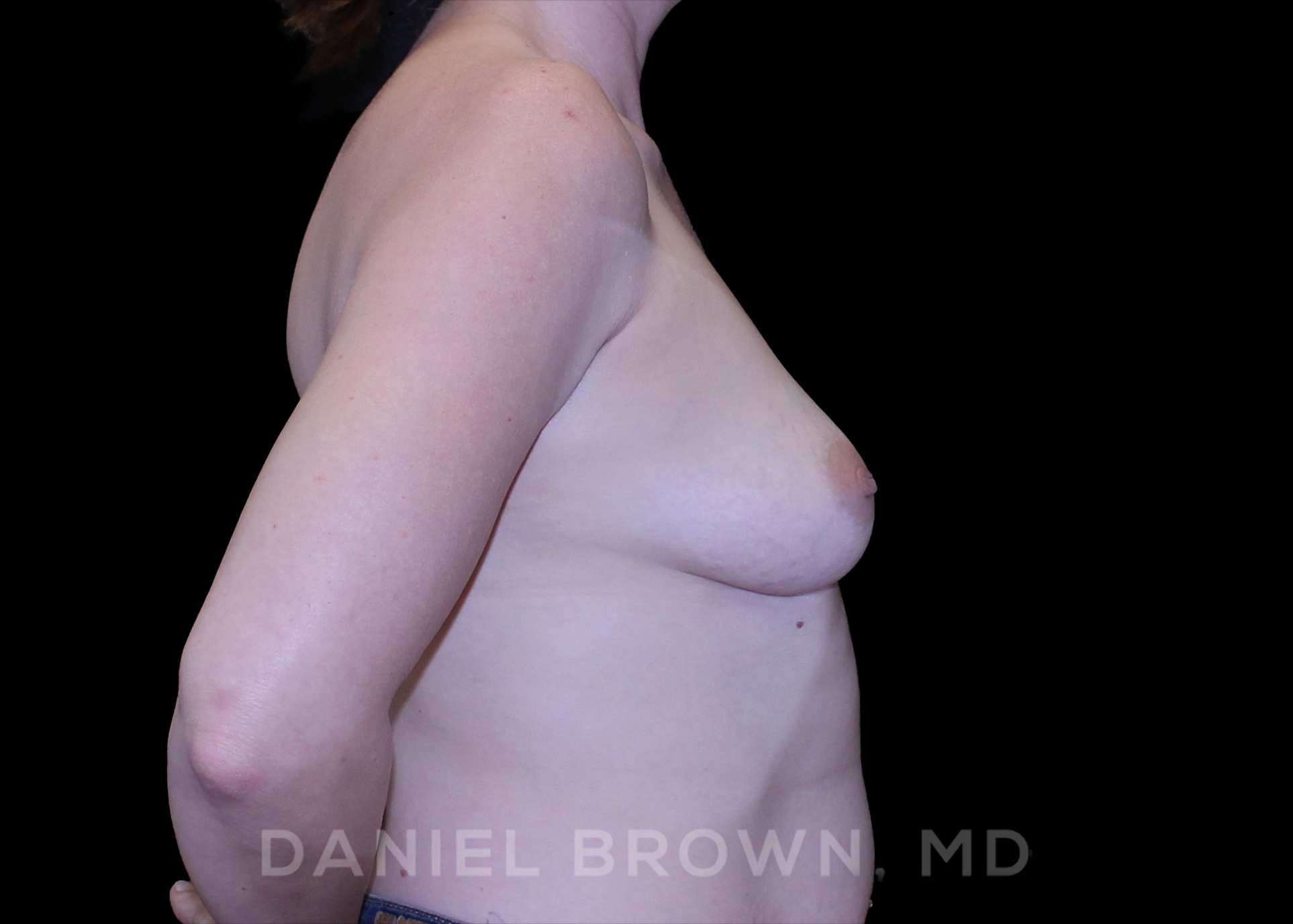 Breast Augmentation Patient Photo - Case 2249 - before view-4