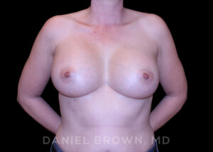 Breast Augmentation - Case 2249 - After