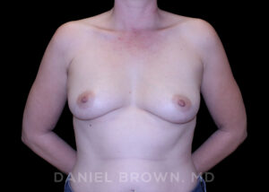 Breast Augmentation - Case 2249 - Before