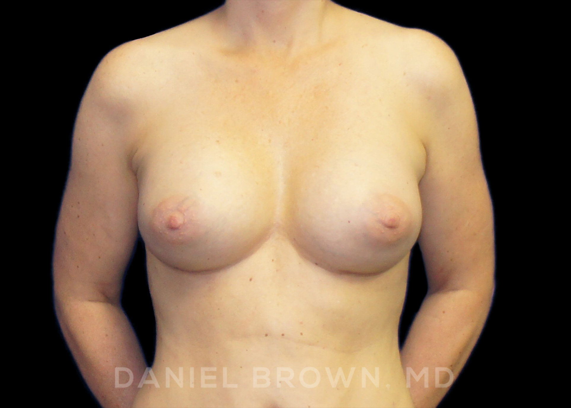Breast Augmentation Patient Photo - Case 2260 - after view