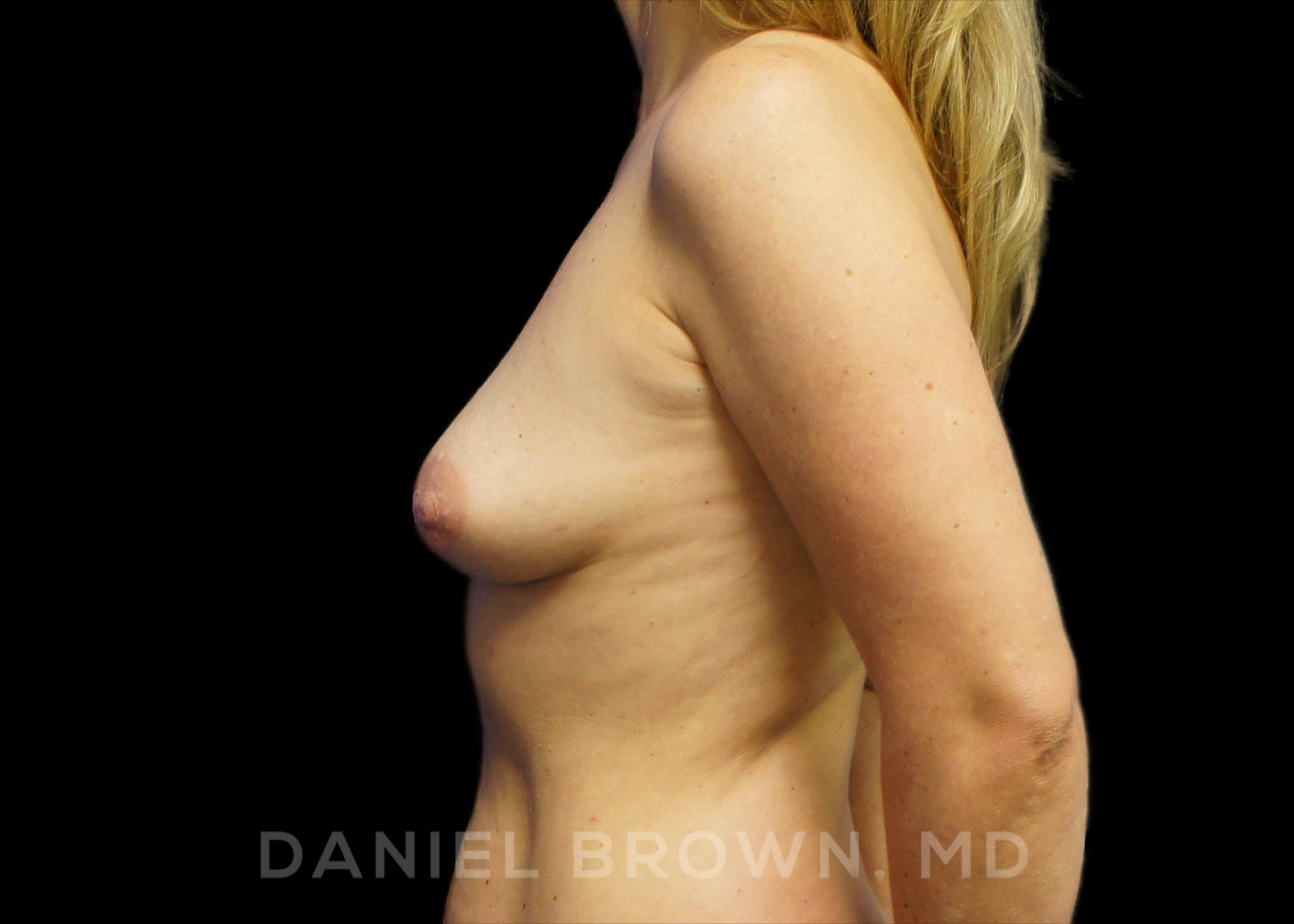 Breast Augmentation Patient Photo - Case 2260 - before view-2