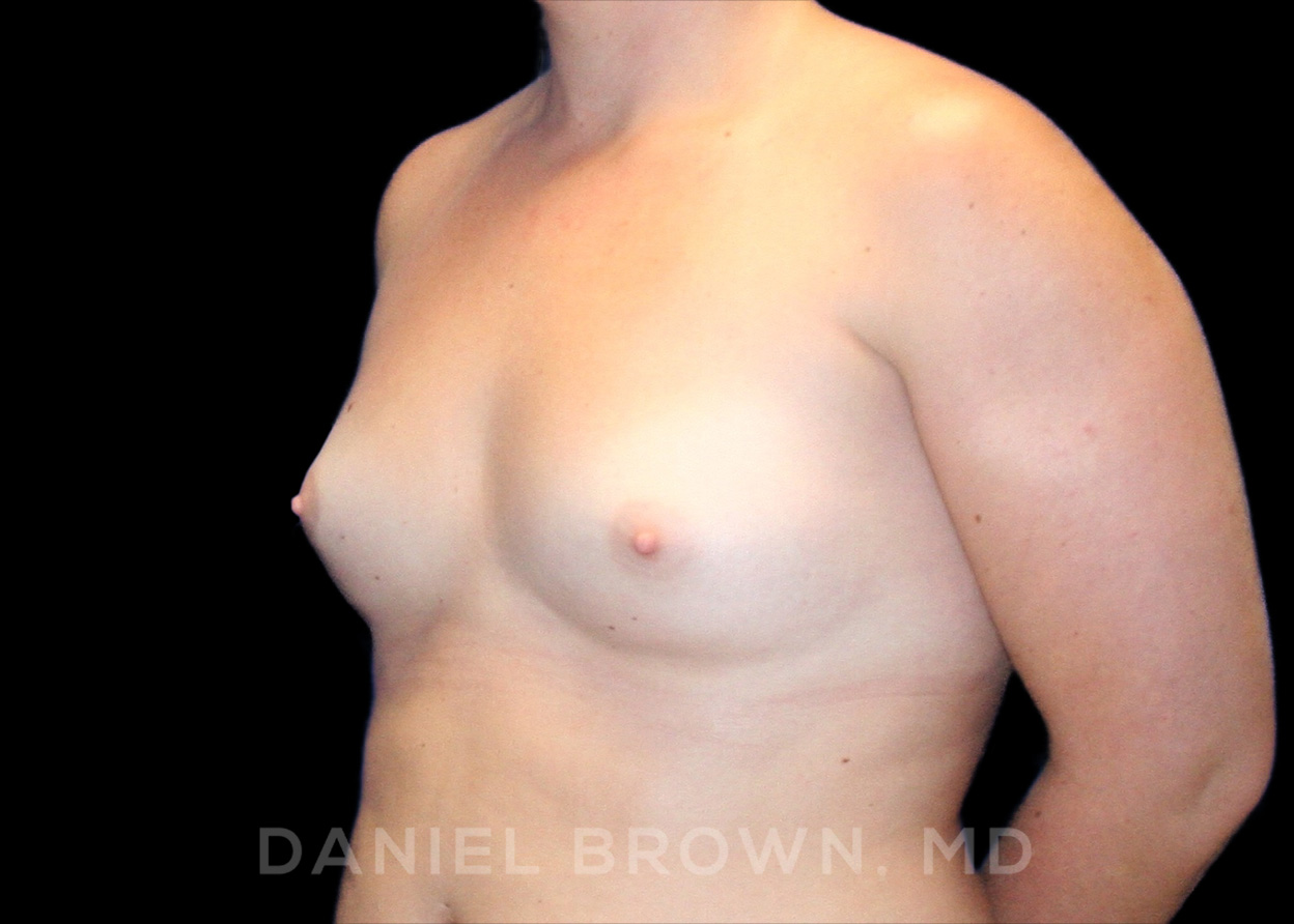 Breast Augmentation Patient Photo - Case 2267 - before view-