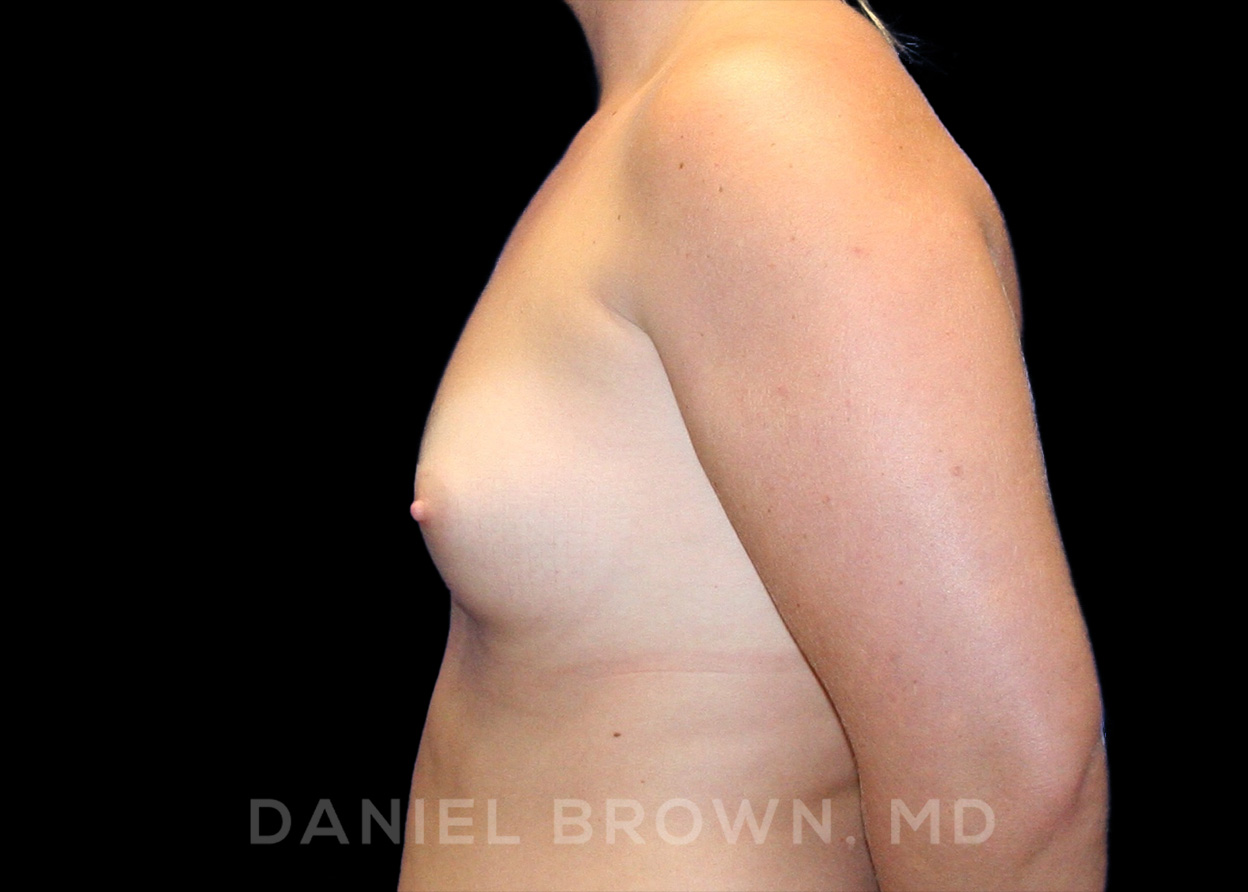 Breast Augmentation Patient Photo - Case 2267 - before view-