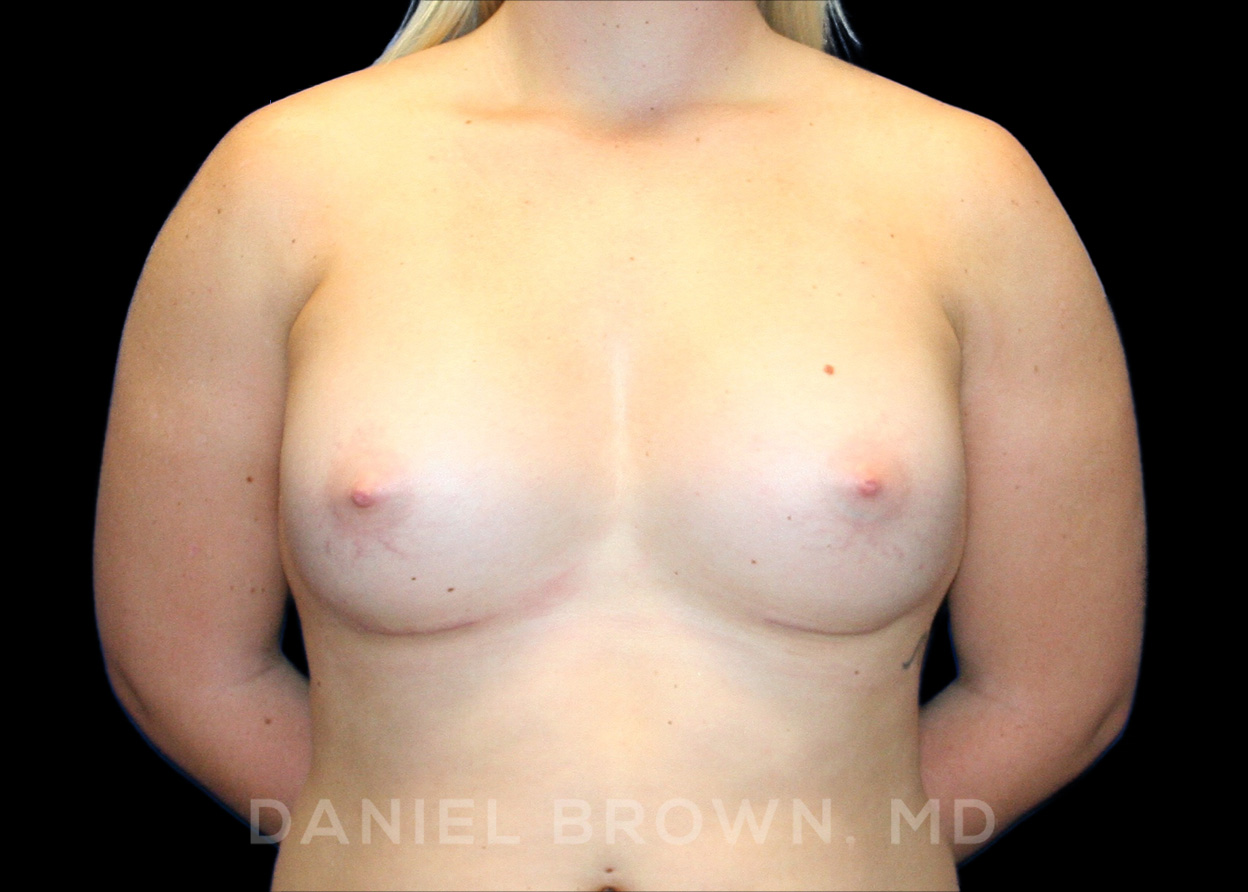 Breast Augmentation Patient Photo - Case 2267 - after view
