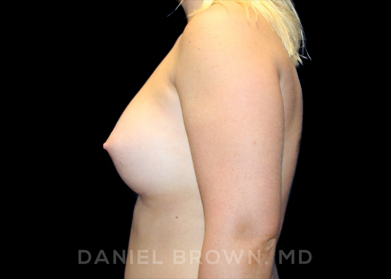 Breast Augmentation Patient Photo - Case 2267 - after view