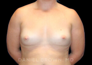 Breast Augmentation - Case 2267 - Before