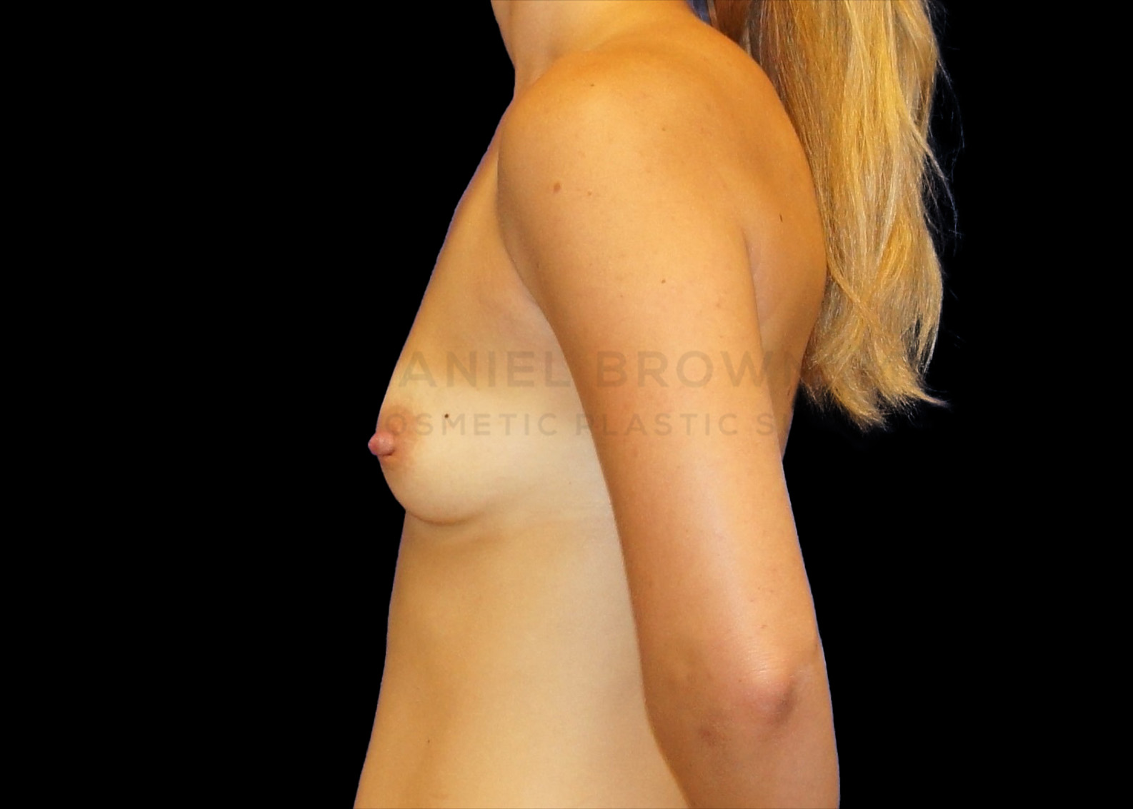 Breast Augmentation Patient Photo - Case 2274 - before view-