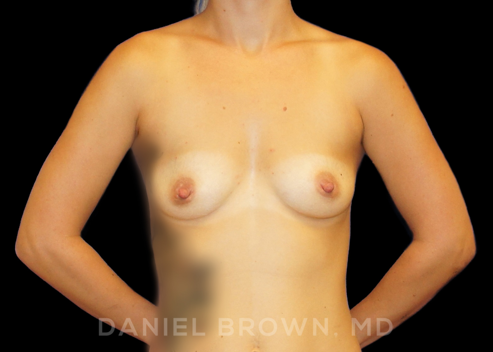 Breast Augmentation Patient Photo - Case 2274 - before view-0