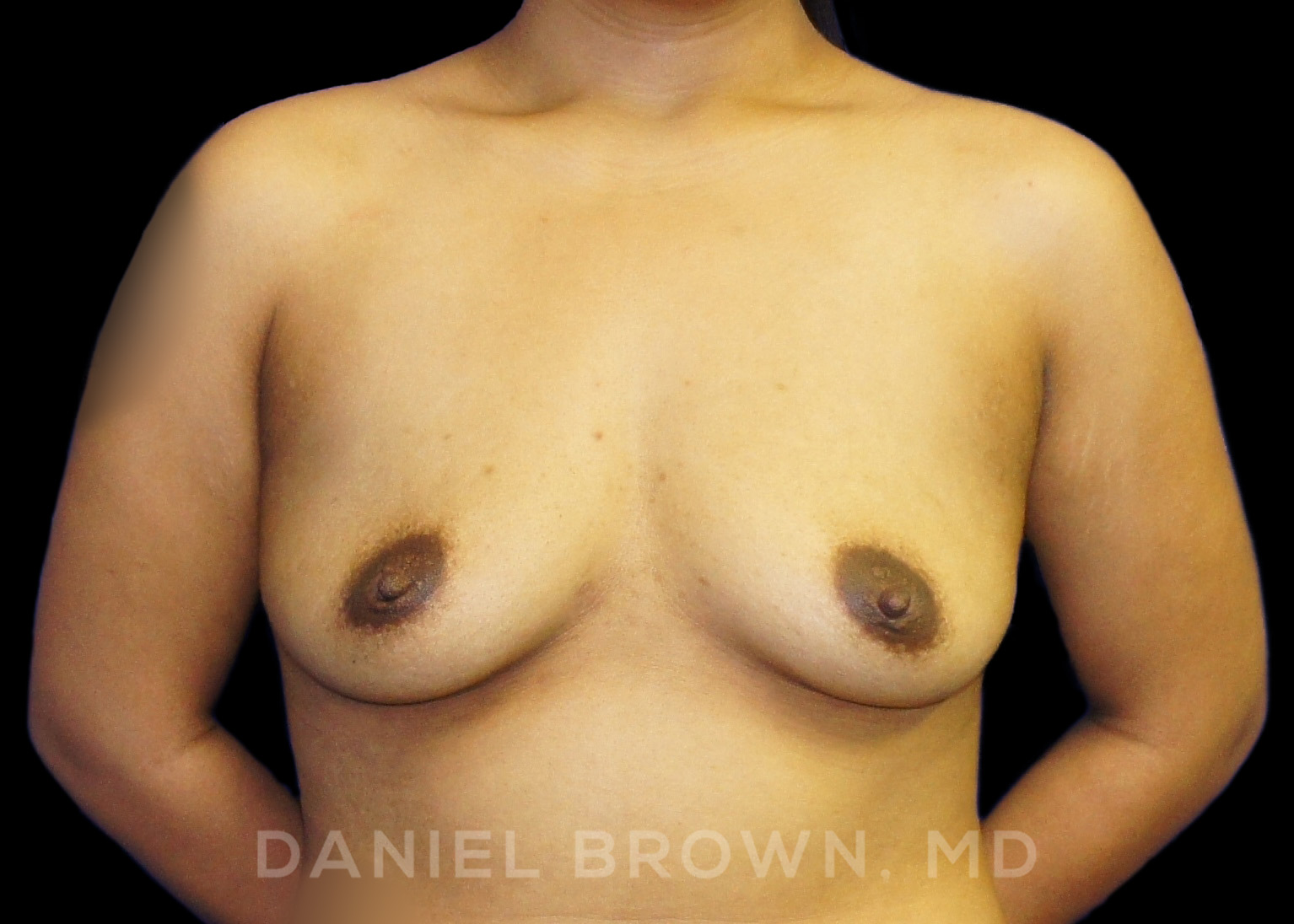 Breast Augmentation Patient Photo - Case 2281 - before view-0