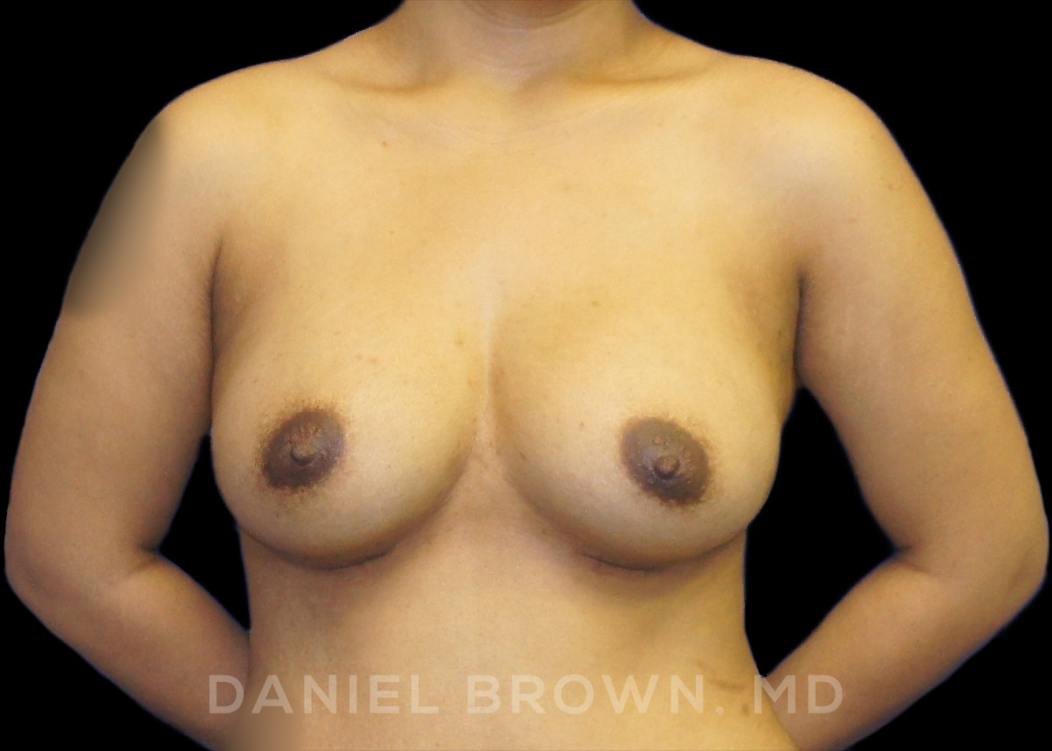 Breast Augmentation Patient Photo - Case 2281 - after view-0