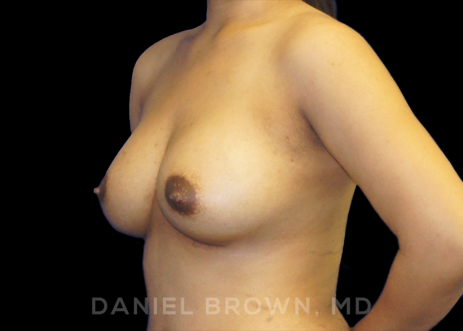 Breast Augmentation Patient Photo - Case 2281 - after view-1