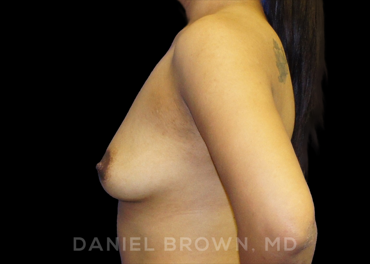 Breast Augmentation Patient Photo - Case 2281 - before view-2