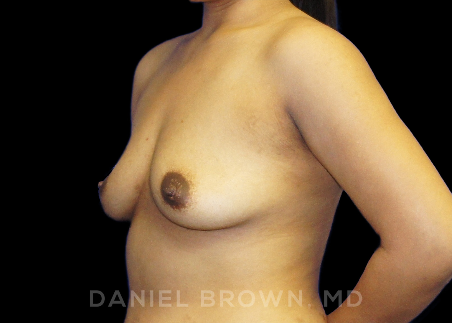 Breast Augmentation Patient Photo - Case 2281 - before view-1