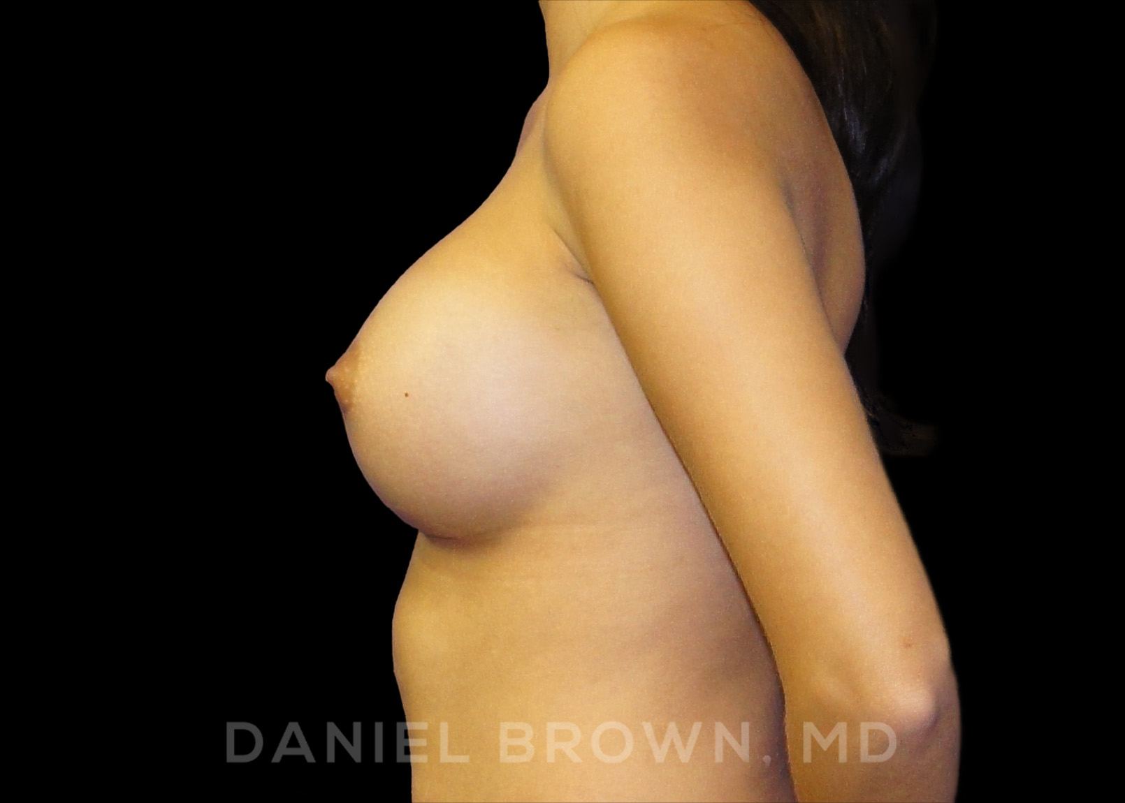 Breast Augmentation Patient Photo - Case 2288 - after view