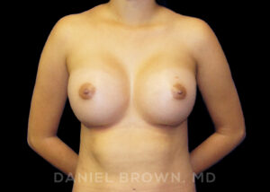 Breast Augmentation - Case 2288 - After