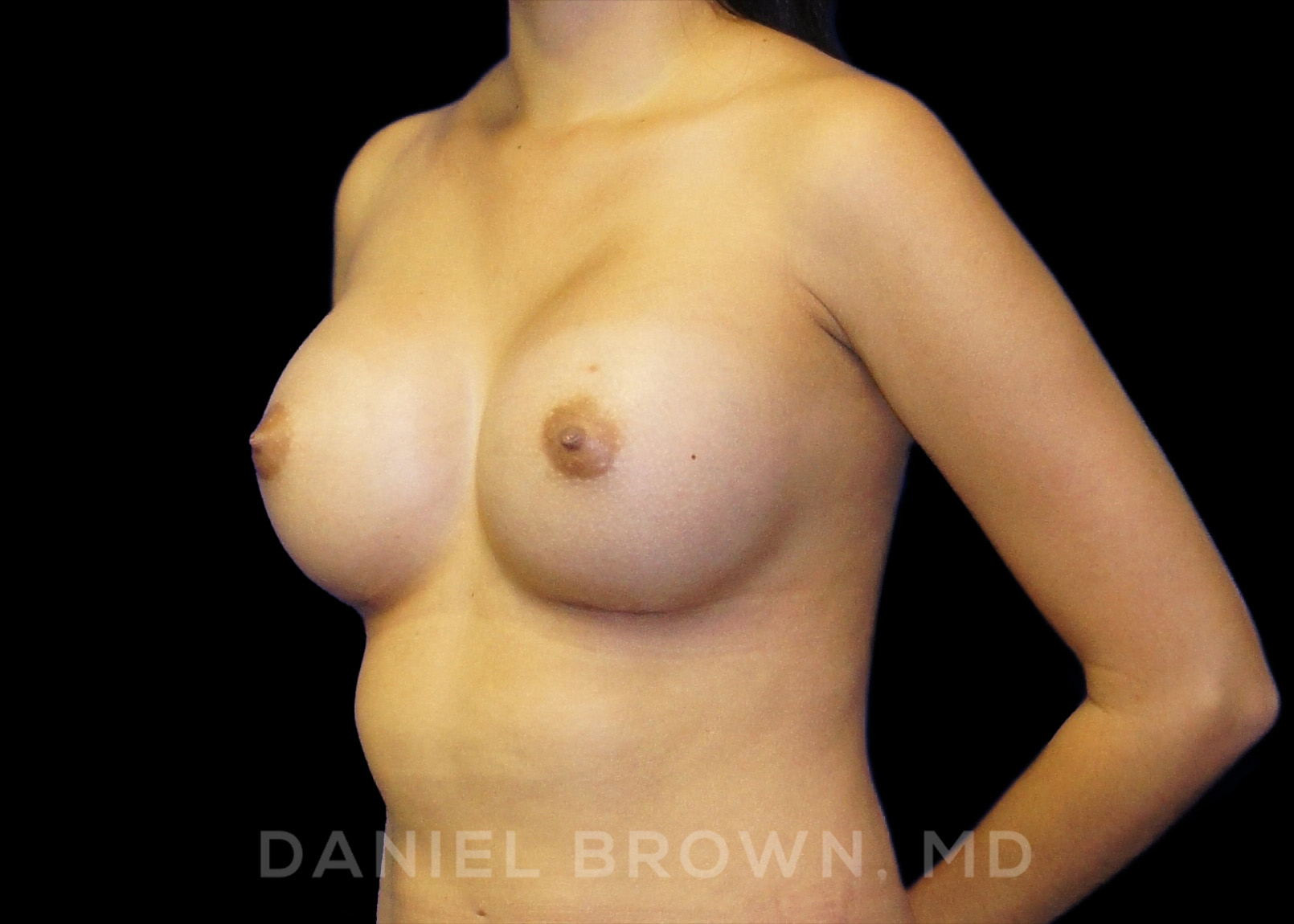 Breast Augmentation Patient Photo - Case 2288 - after view