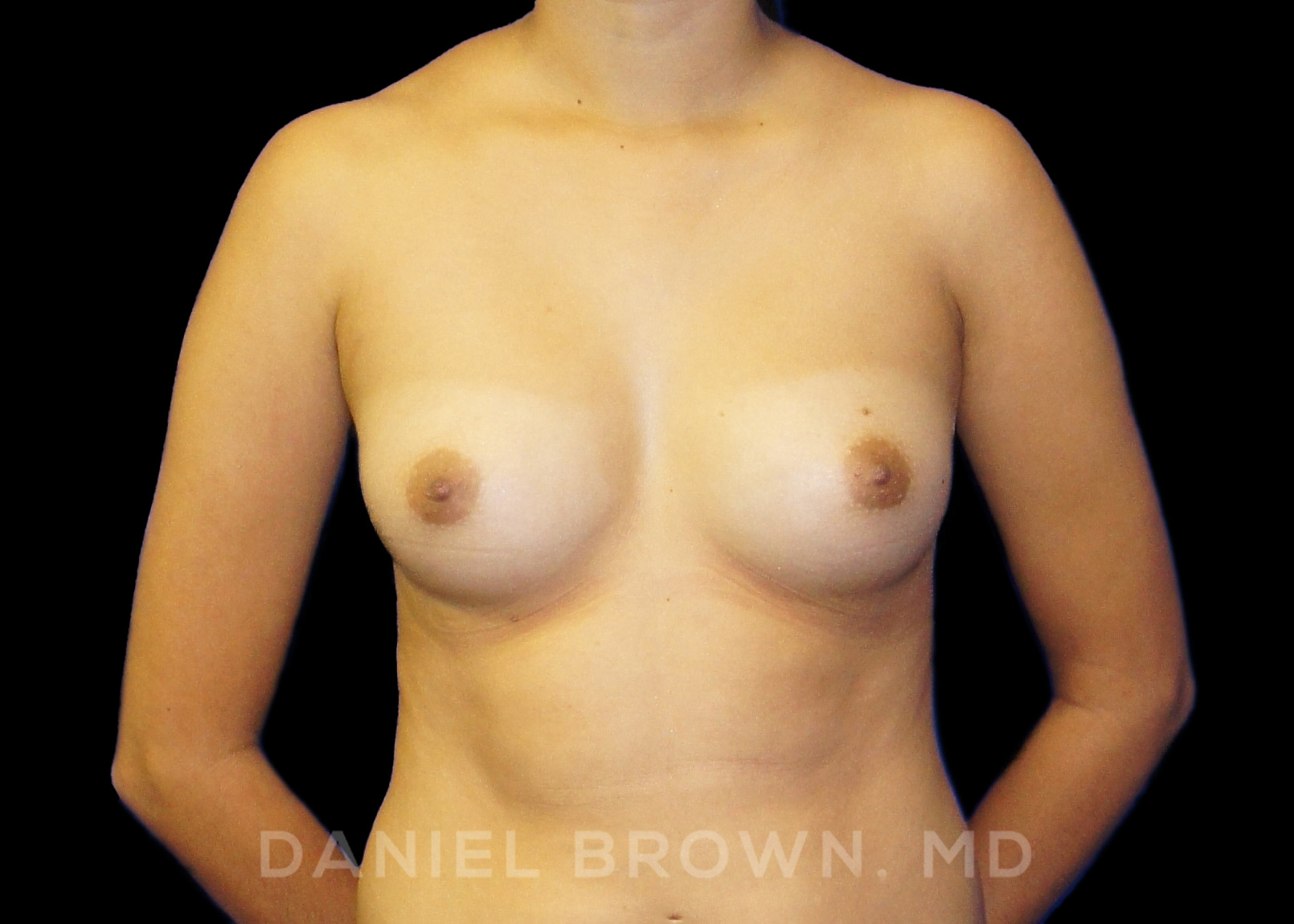 Breast Augmentation Patient Photo - Case 2288 - before view-