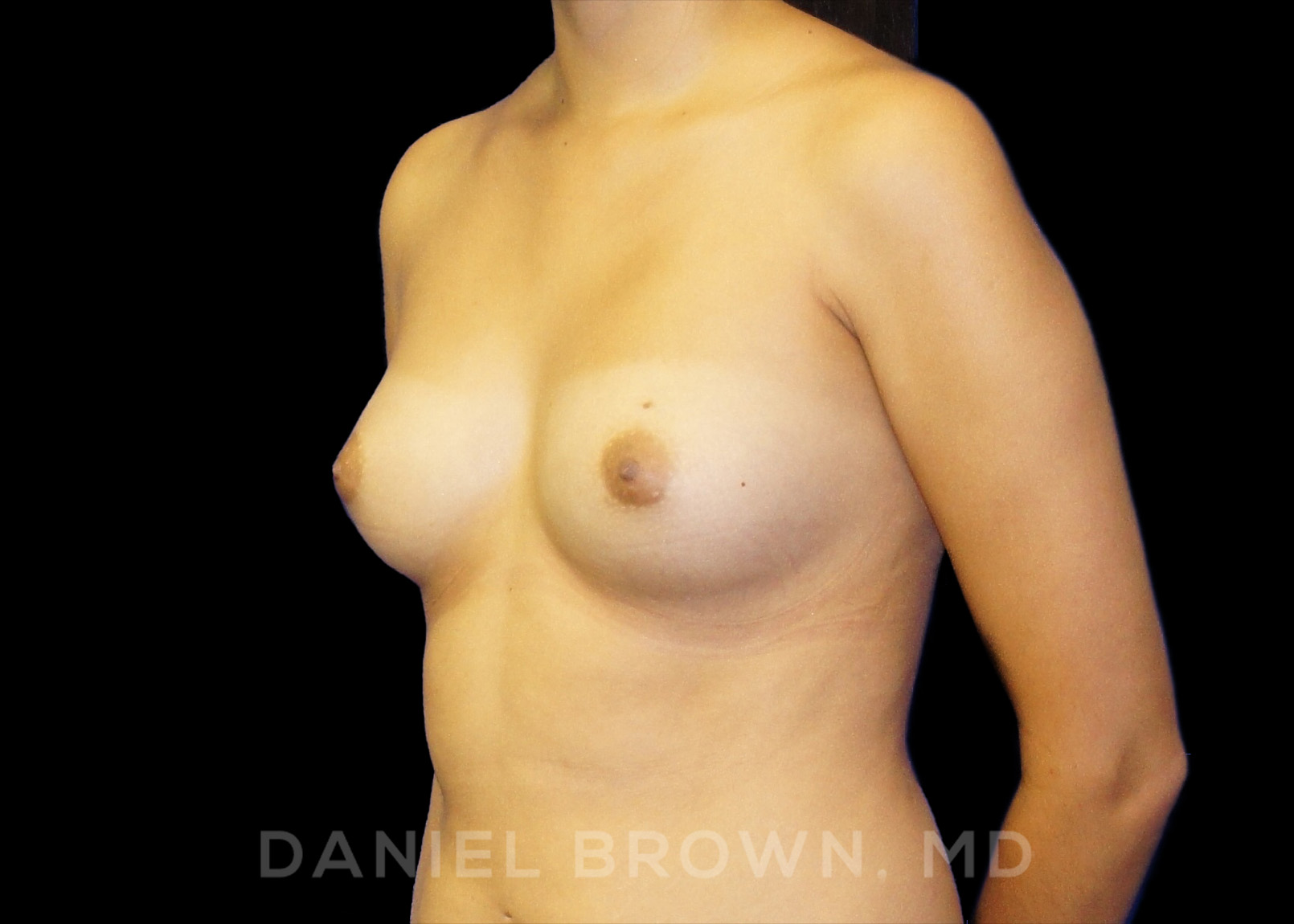 Breast Augmentation Patient Photo - Case 2288 - before view-