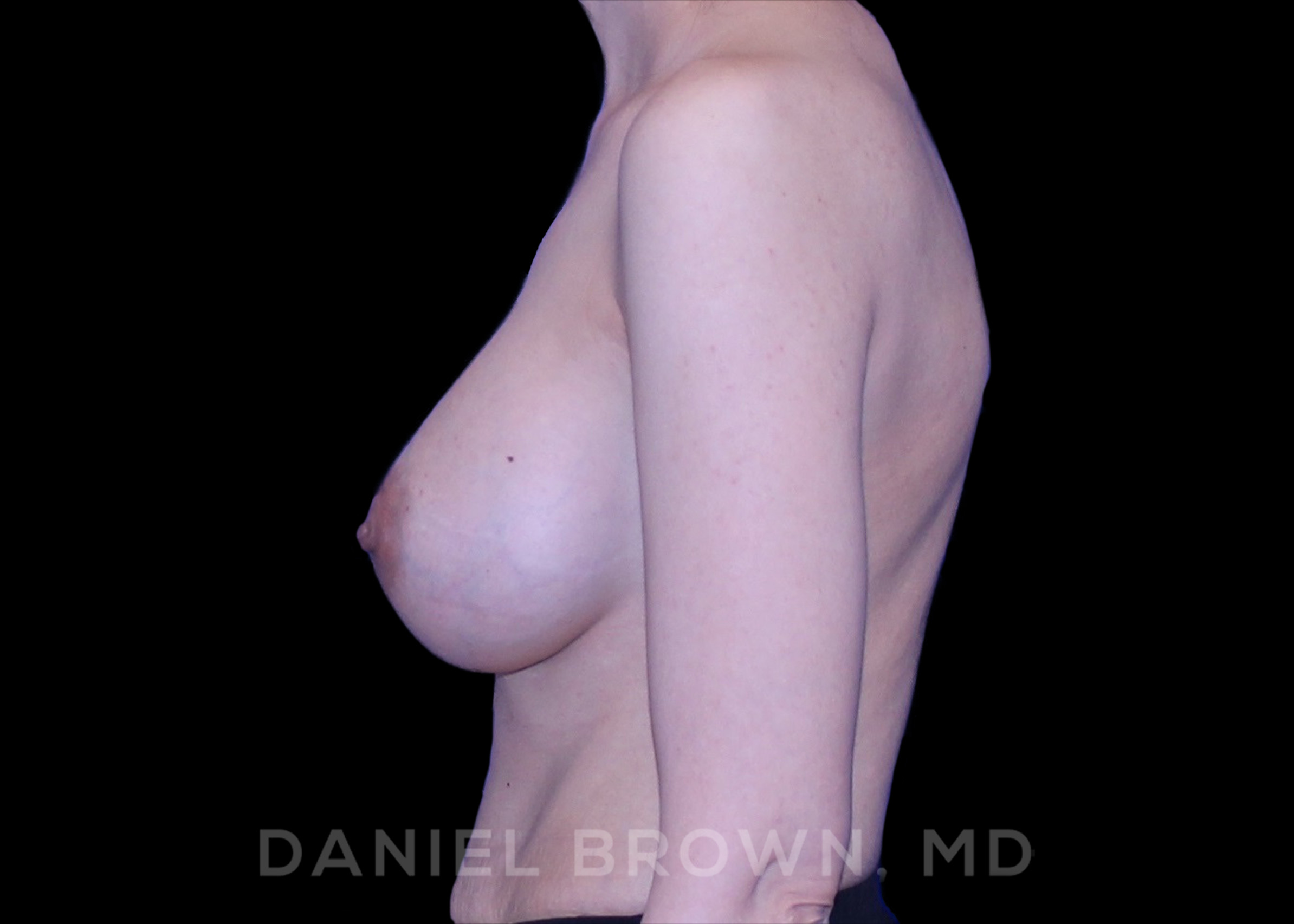Breast Augmentation Patient Photo - Case 2295 - after view-2