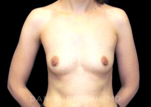 Breast Augmentation - Case 2295 - Before