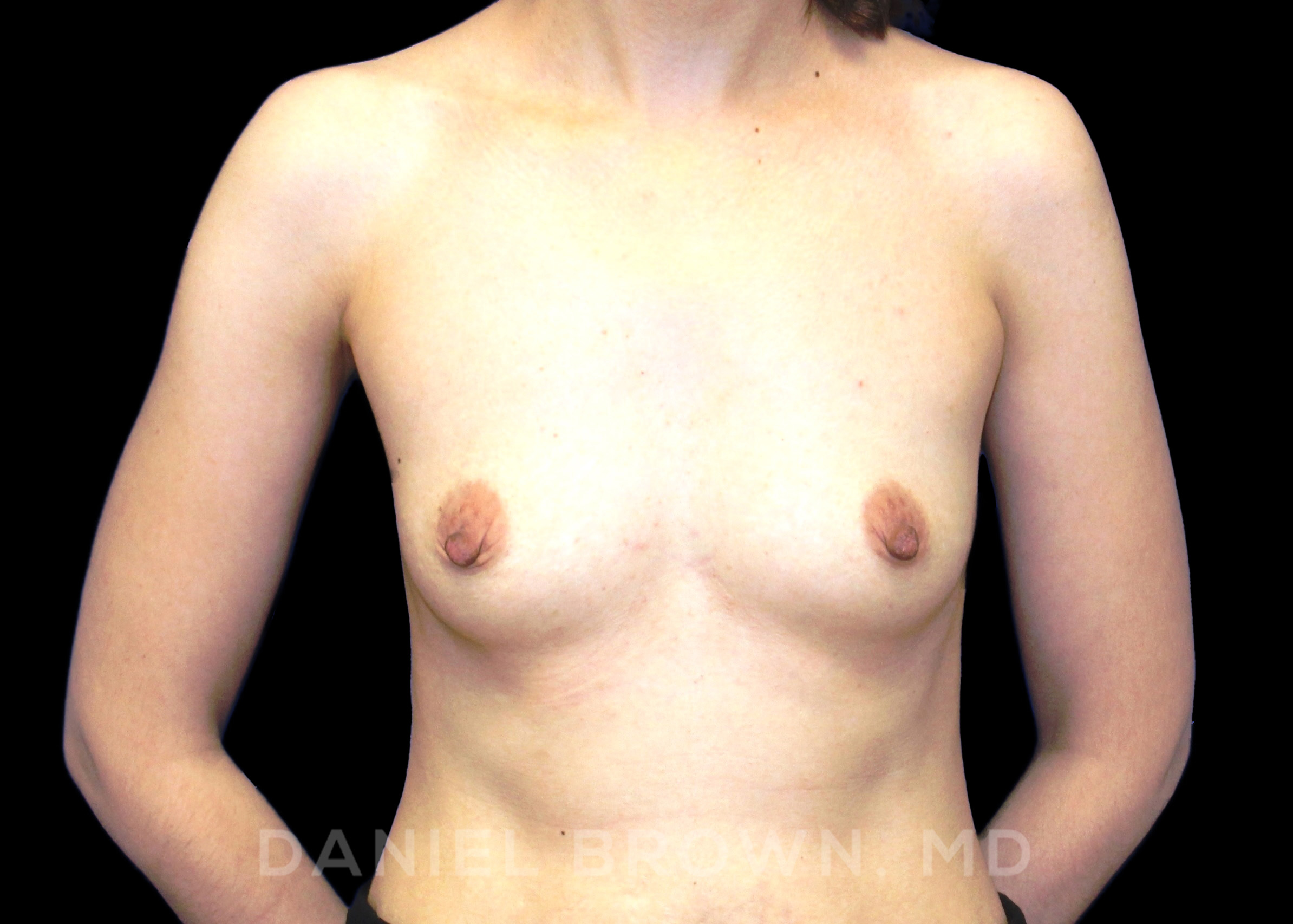 Breast Augmentation Patient Photo - Case 2295 - before view-0