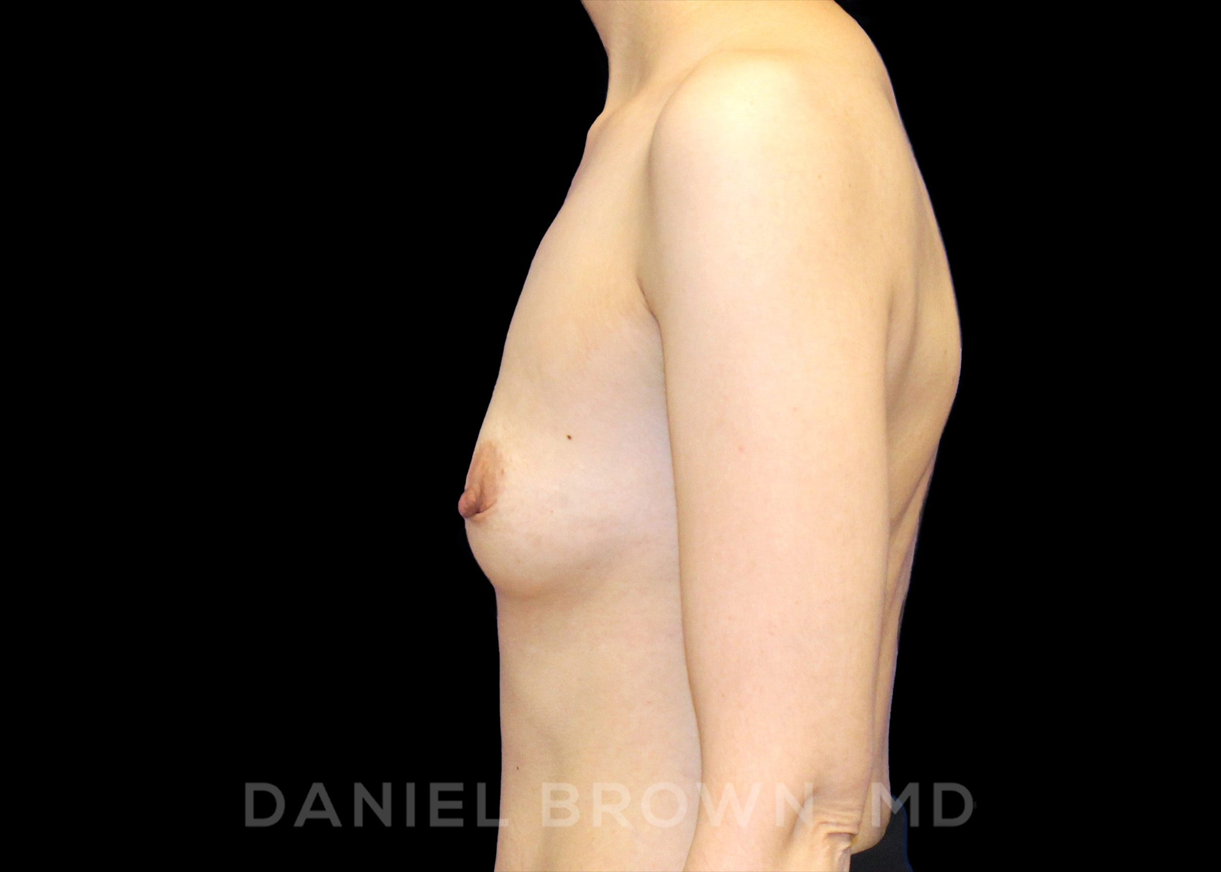 Breast Augmentation Patient Photo - Case 2295 - before view-2