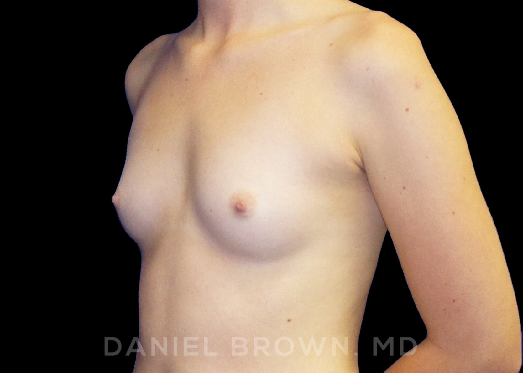 Breast Augmentation Patient Photo - Case 2302 - before view-1