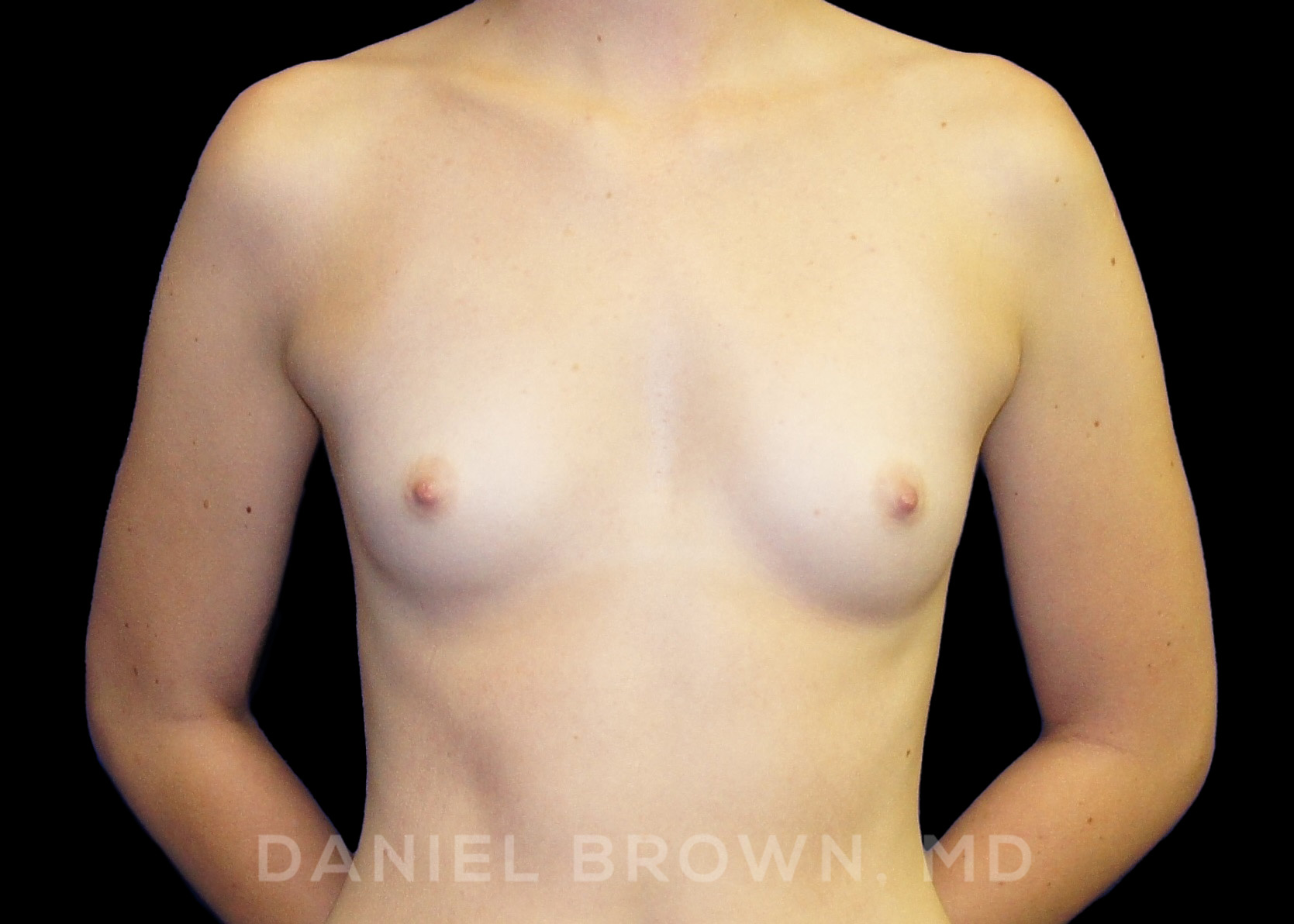 Breast Augmentation Patient Photo - Case 2302 - before view-0