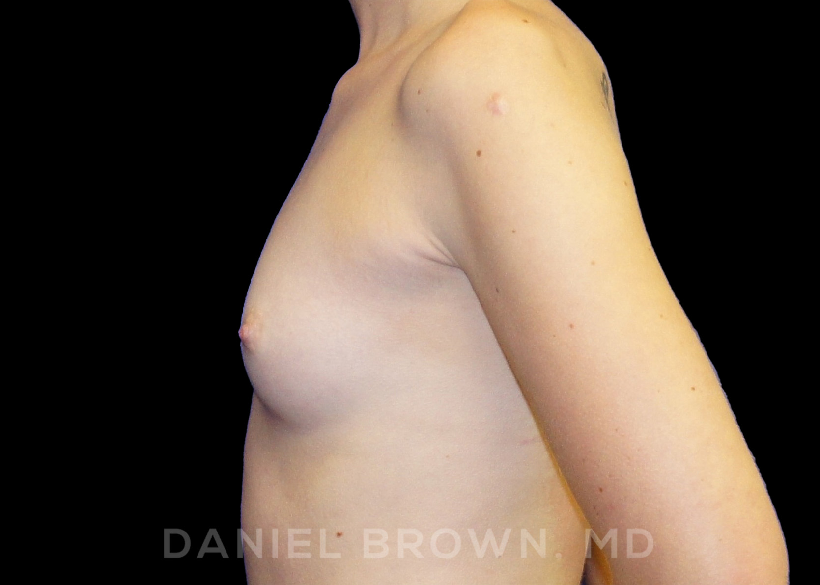 Breast Augmentation Patient Photo - Case 2302 - before view-