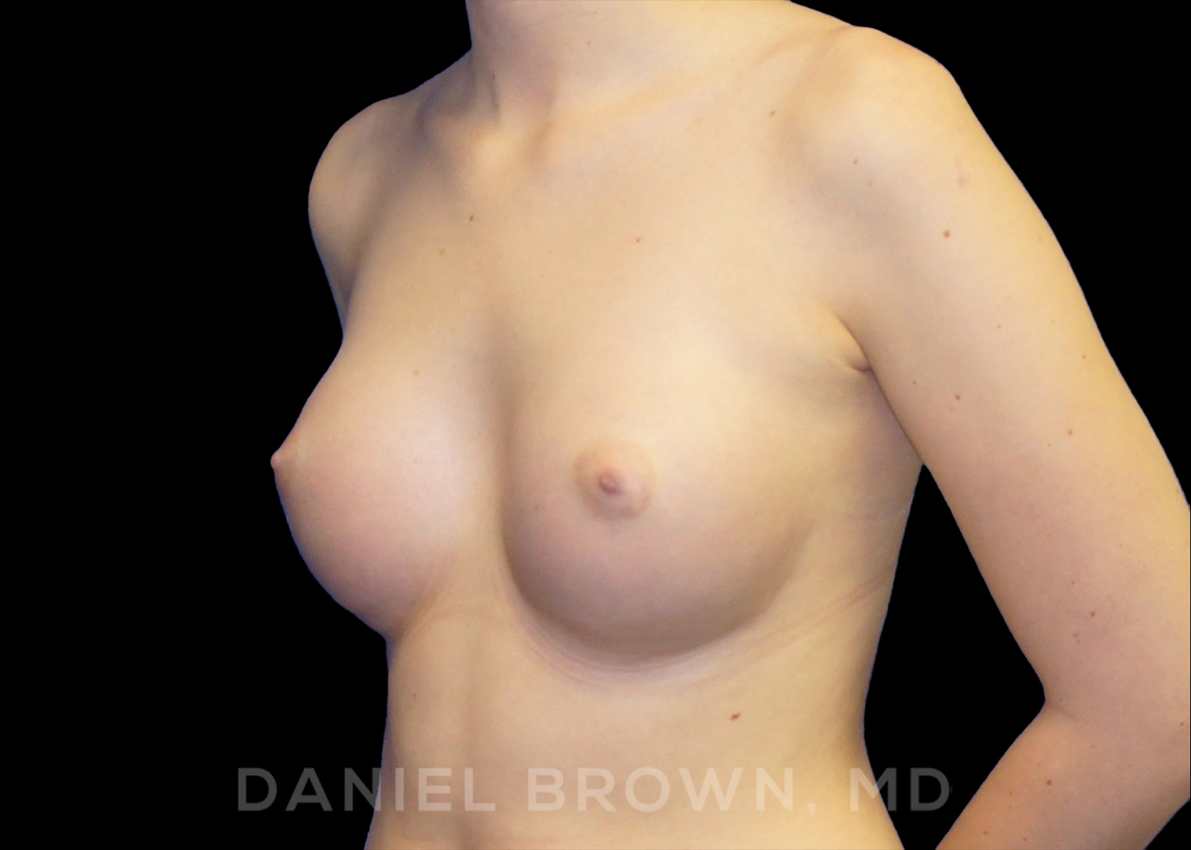 Breast Augmentation Patient Photo - Case 2302 - after view