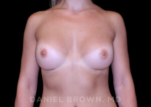 Breast Augmentation - Case 2309 - After