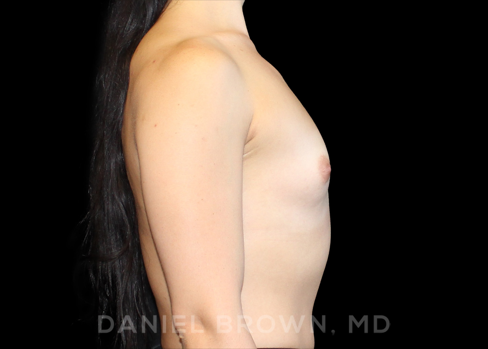 Breast Augmentation Patient Photo - Case 2309 - before view-