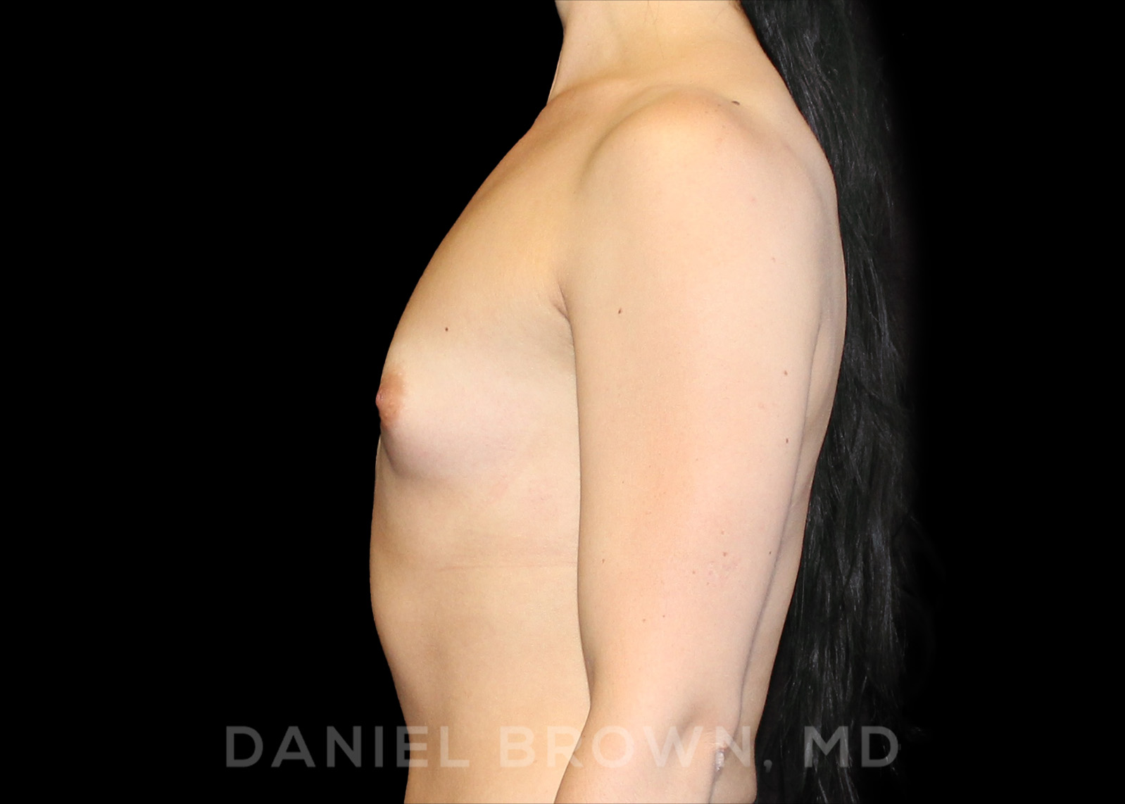 Breast Augmentation Patient Photo - Case 2309 - before view-3