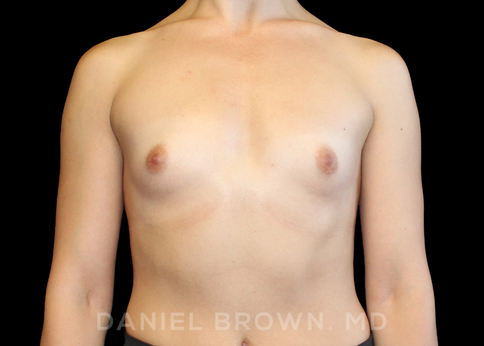 Breast Augmentation Patient Photo - Case 2309 - before view-
