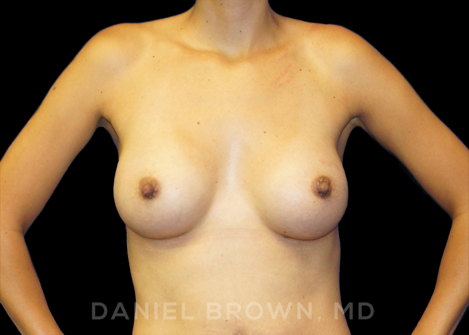 Breast Augmentation Patient Photo - Case 2320 - after view-0