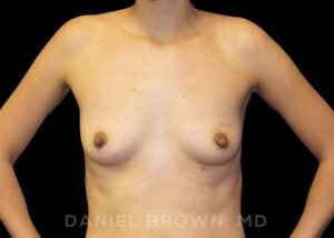 Breast Augmentation - Case 2320 - Before