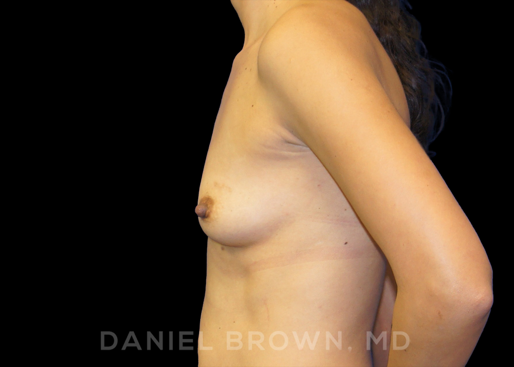 Breast Augmentation Patient Photo - Case 2320 - before view-