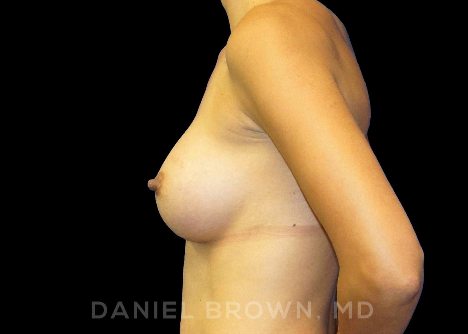 Breast Augmentation Patient Photo - Case 2320 - after view-2