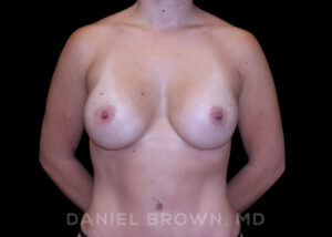 Breast Augmentation - Case 2327 - After