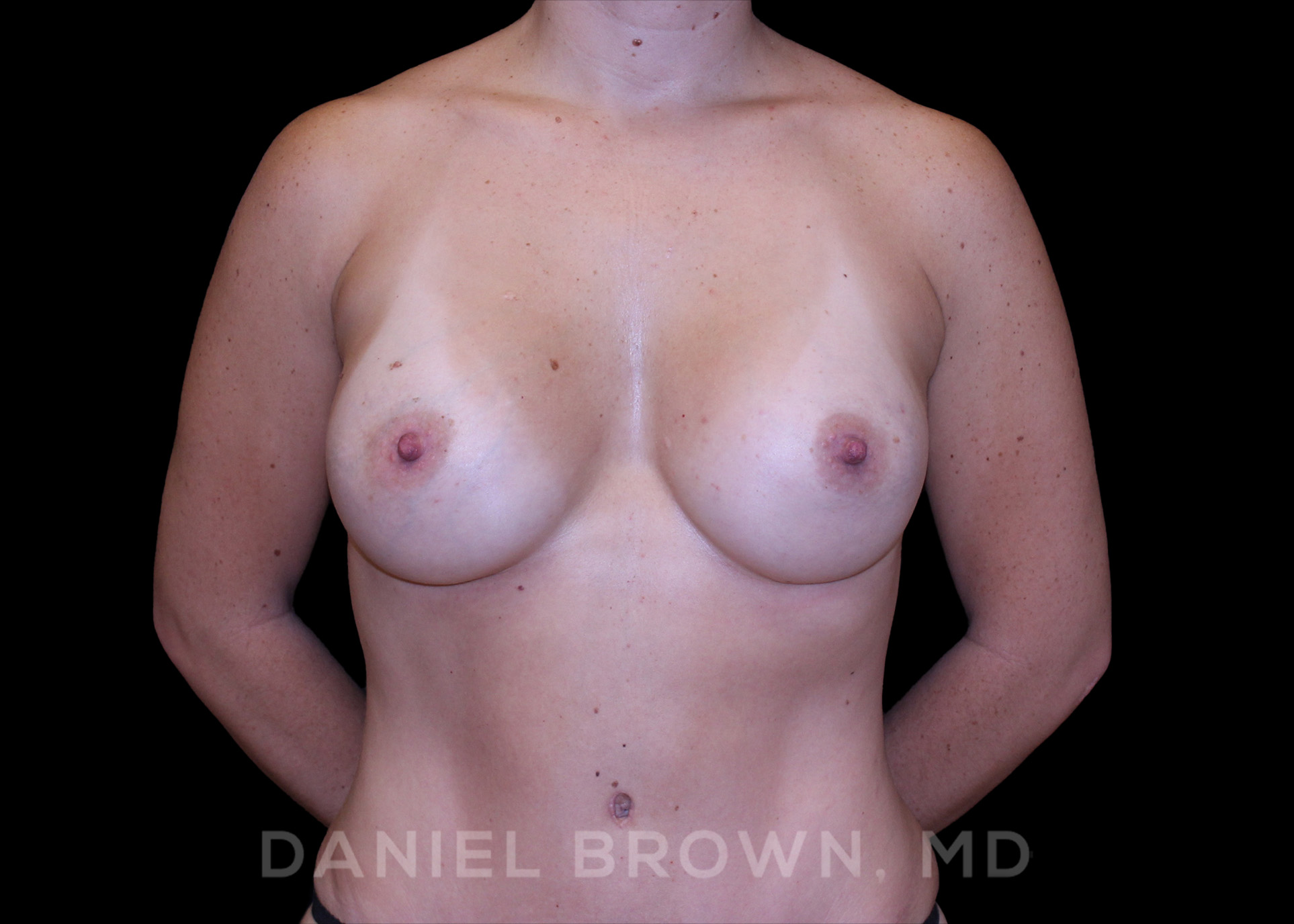 Breast Augmentation Patient Photo - Case 2327 - after view