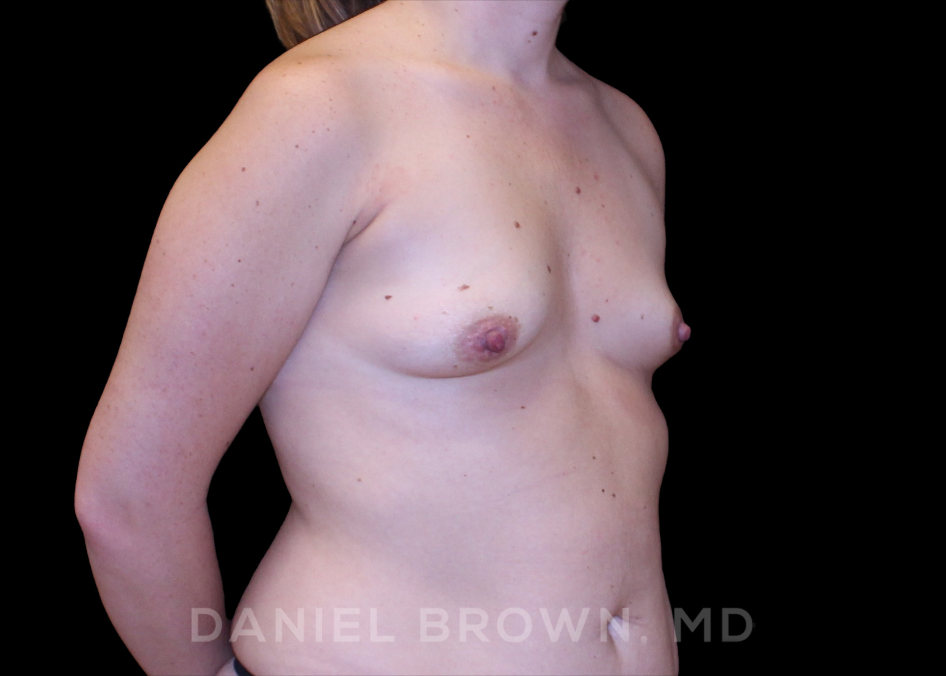 Breast Augmentation Patient Photo - Case 2327 - before view-2
