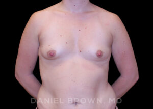 Breast Augmentation - Case 2327 - Before