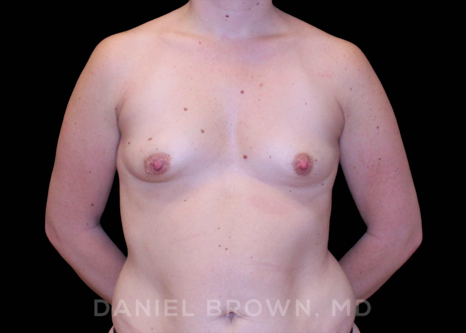 Breast Augmentation Patient Photo - Case 2327 - before view-0