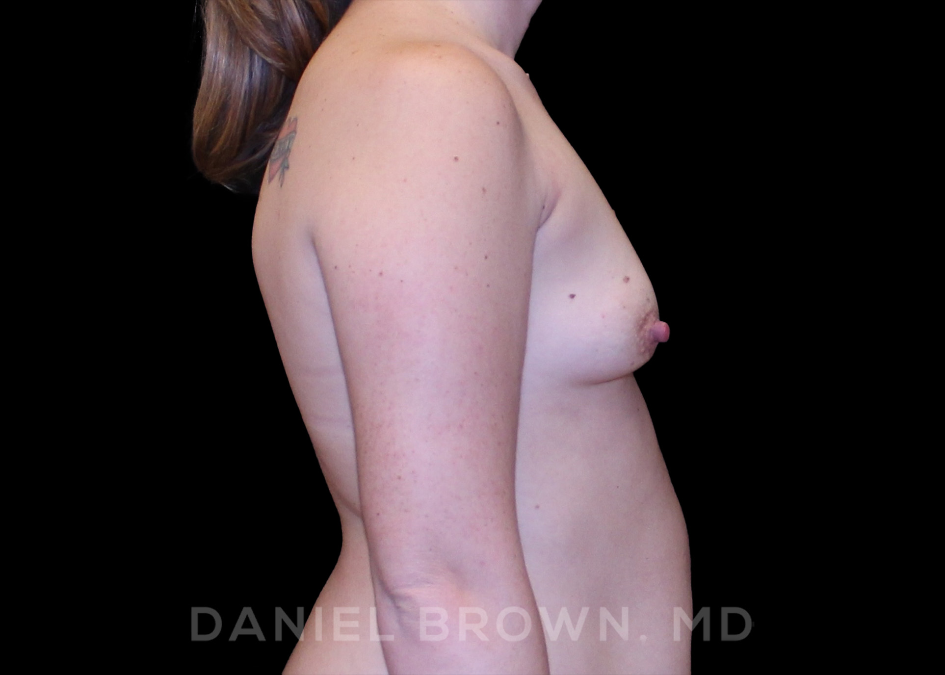 Breast Augmentation Patient Photo - Case 2327 - before view-4