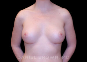 Breast Augmentation - Case 2338 - After