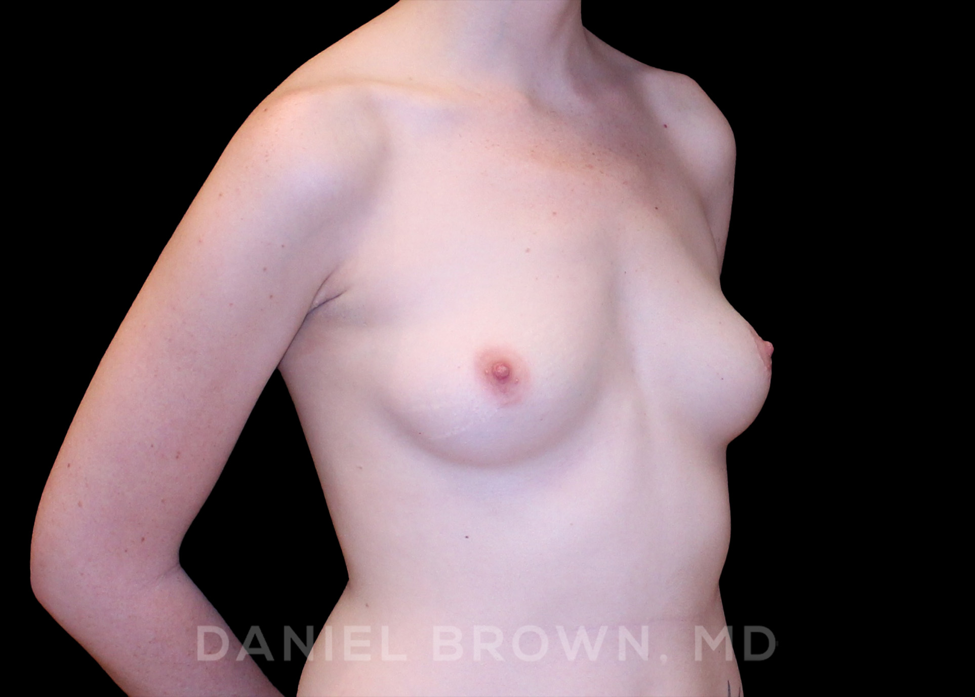Breast Augmentation Patient Photo - Case 2338 - before view-